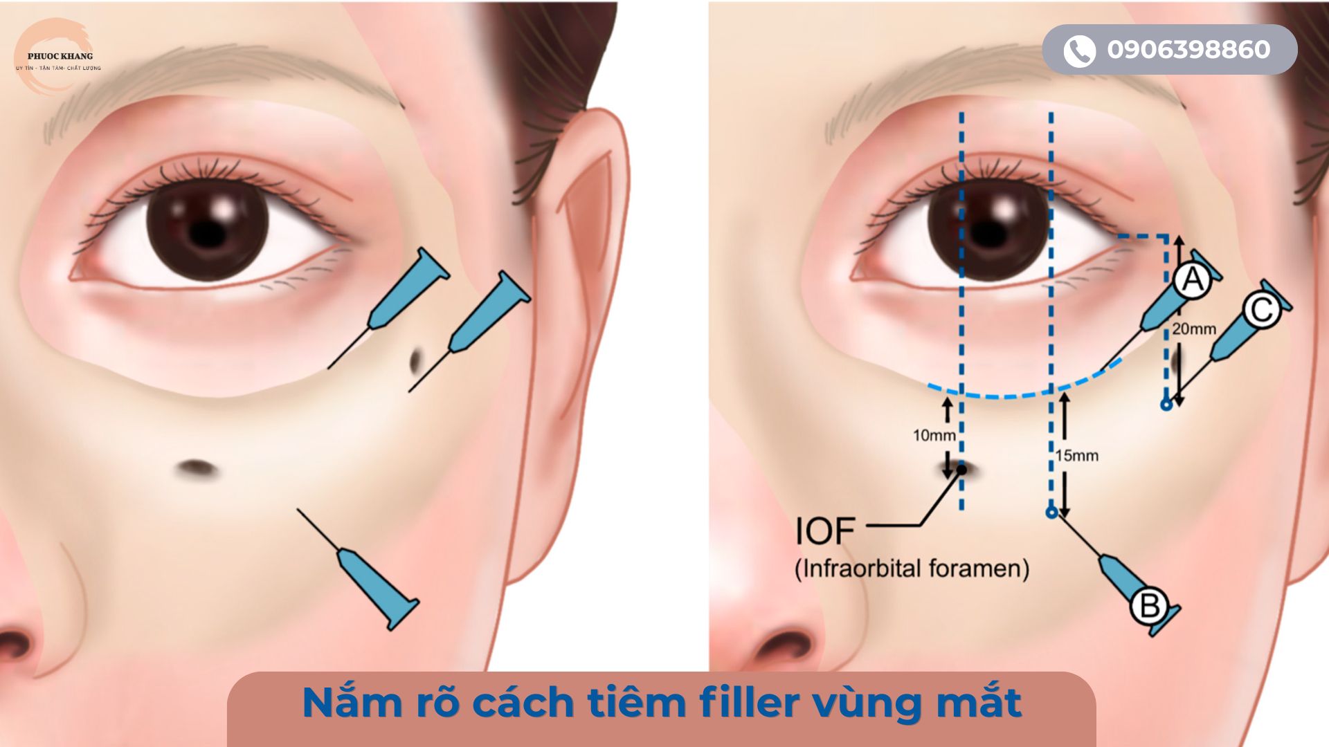 Nắm rõ cách tiêm filler vùng mắt là quan trọng nhất khi tiêm