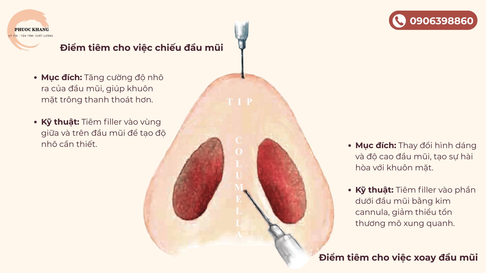Kỹ thuật tiêm mũi bằng kim cannula