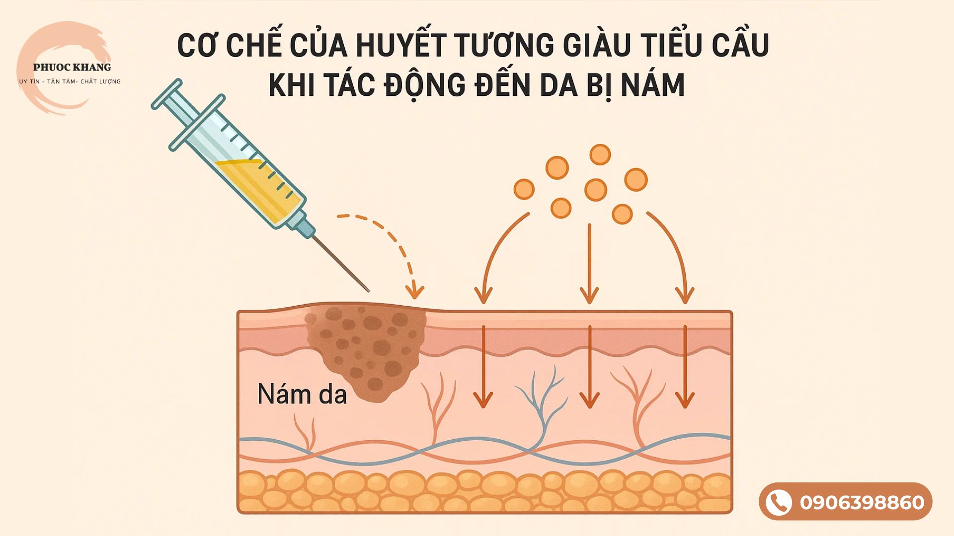 Cơ chế của huyết tương giàu tiểu cầu khi tác động đến da bị nám