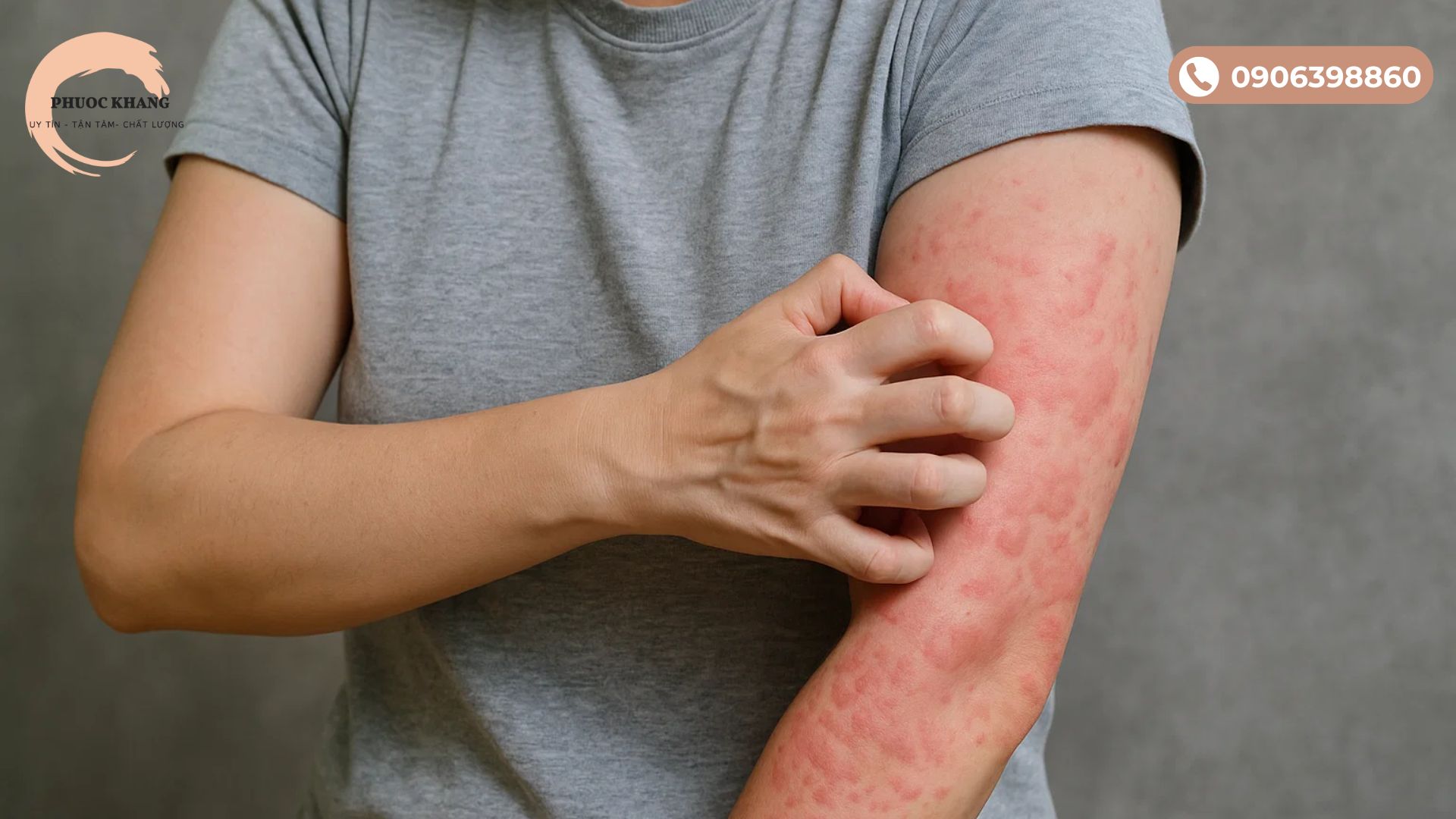 Ngứa dữ dội là phản ứng bất thường sau tiêm PRP