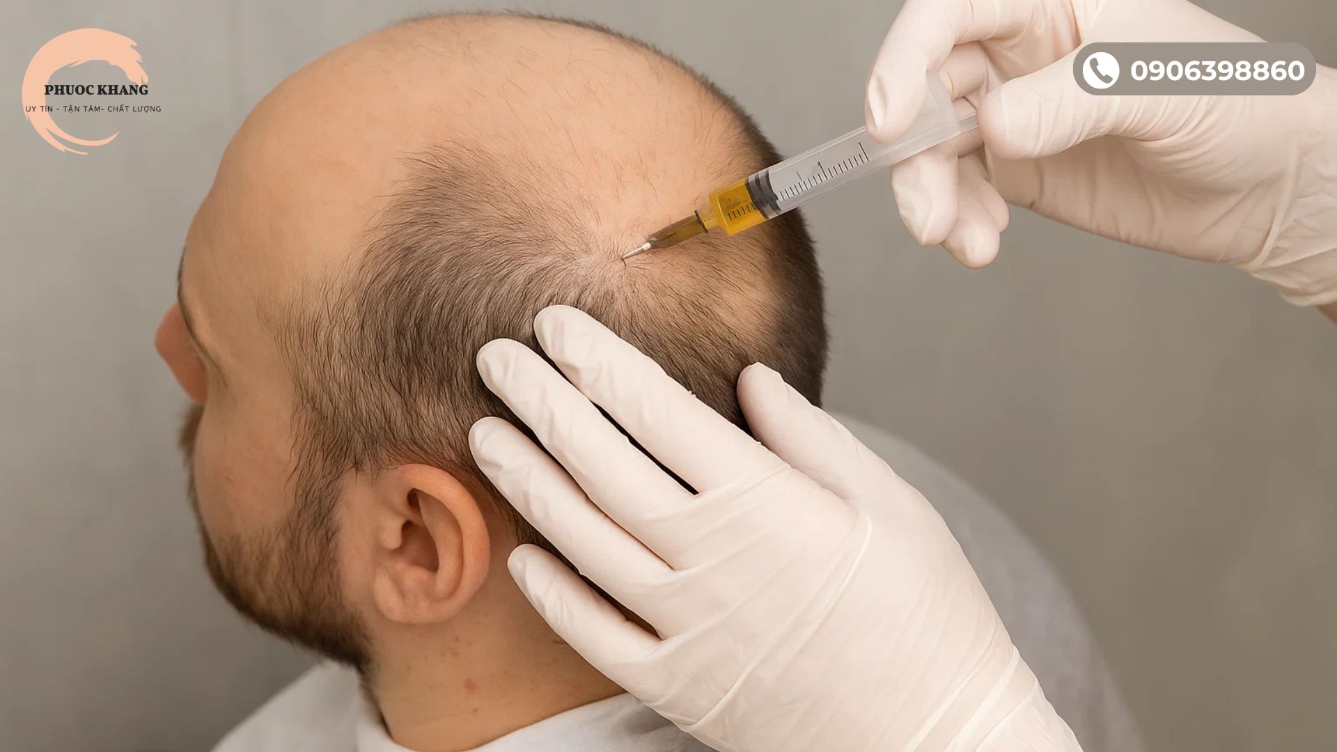 PRP có tác dụng gì cho tóc?